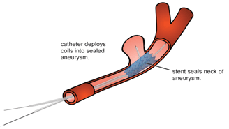 Placement of Stent